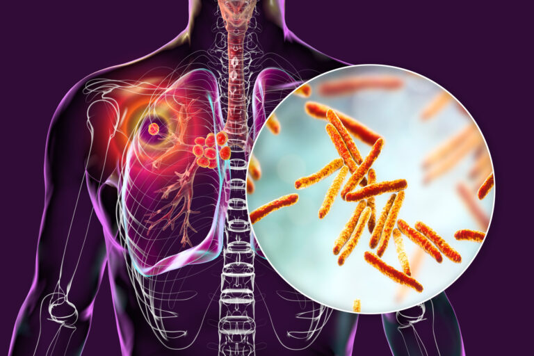 Tuberculosis – How do we get it?